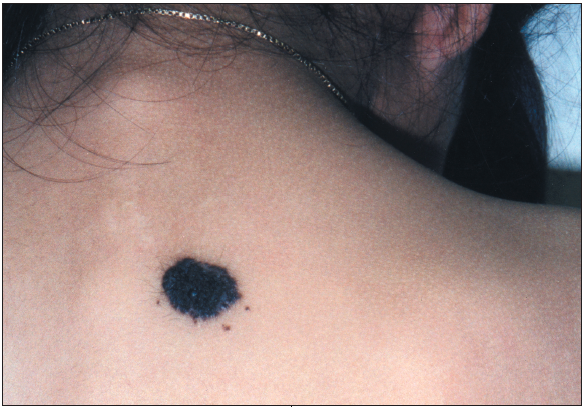The Melanocytic Nevus: Understanding Skin Moles and Their Significance