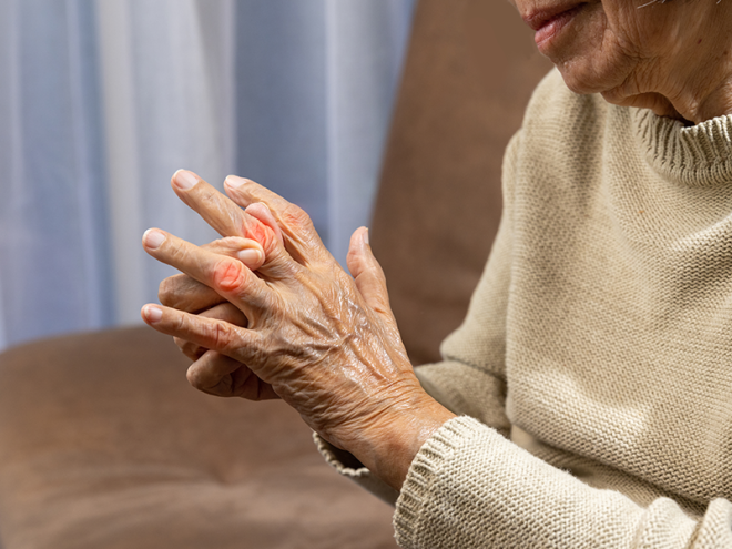 Beyond Skin Deep: Unraveling the 5 Types of Psoriatic Arthritis
