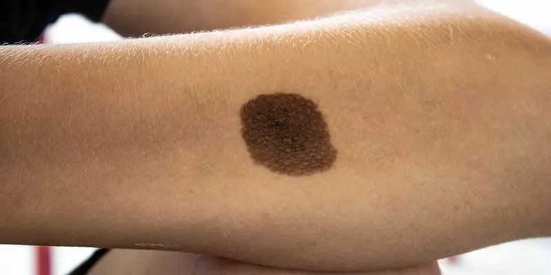 The Melanocytic Nevus: Understanding Skin Moles and Their Significance