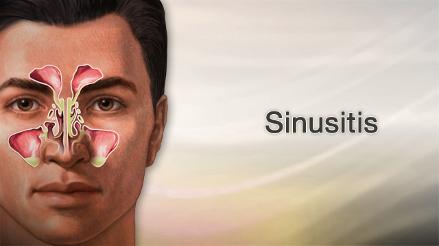 Home Remedies for Sinus Infections