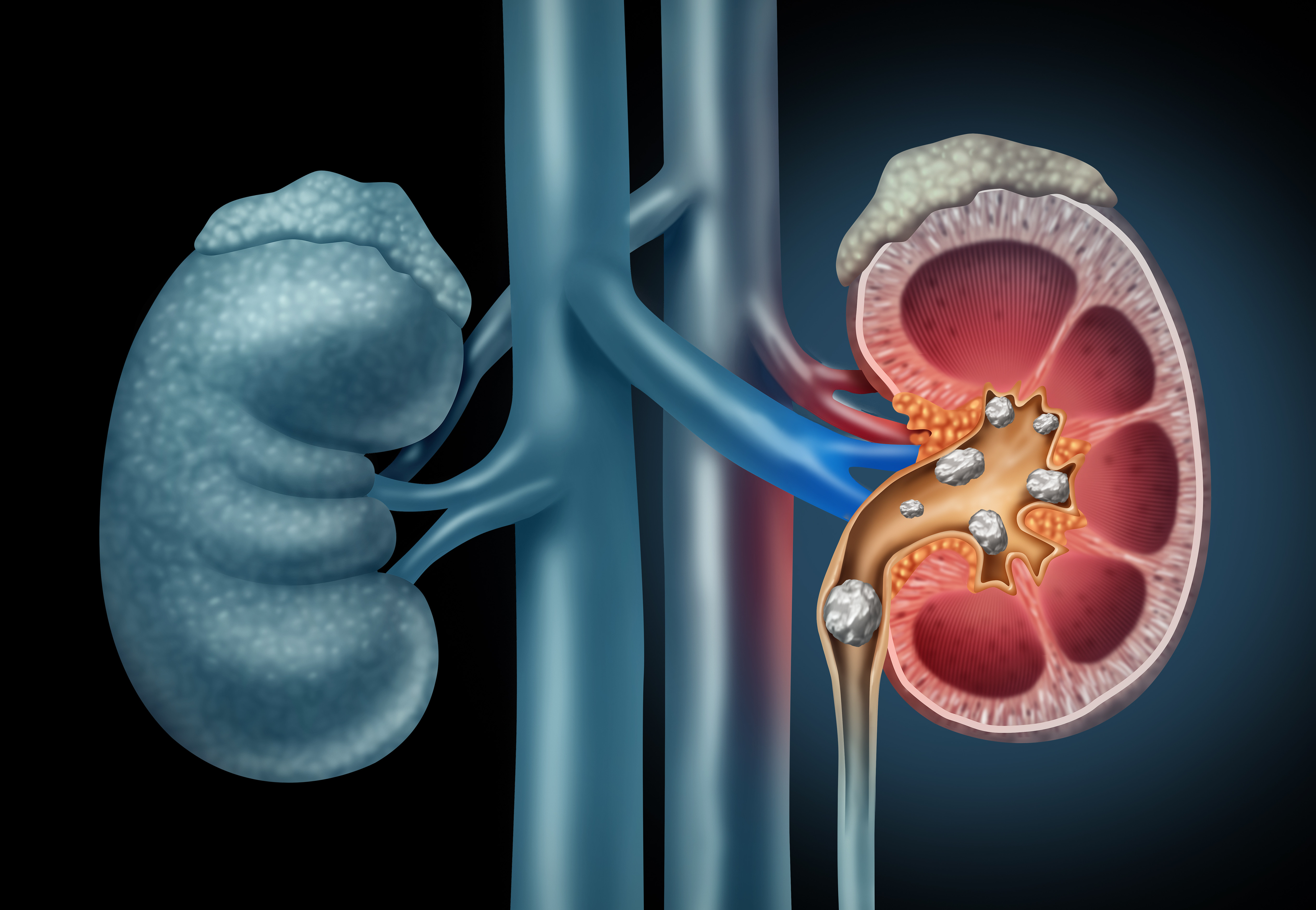 Home Remedies for Renal Stones